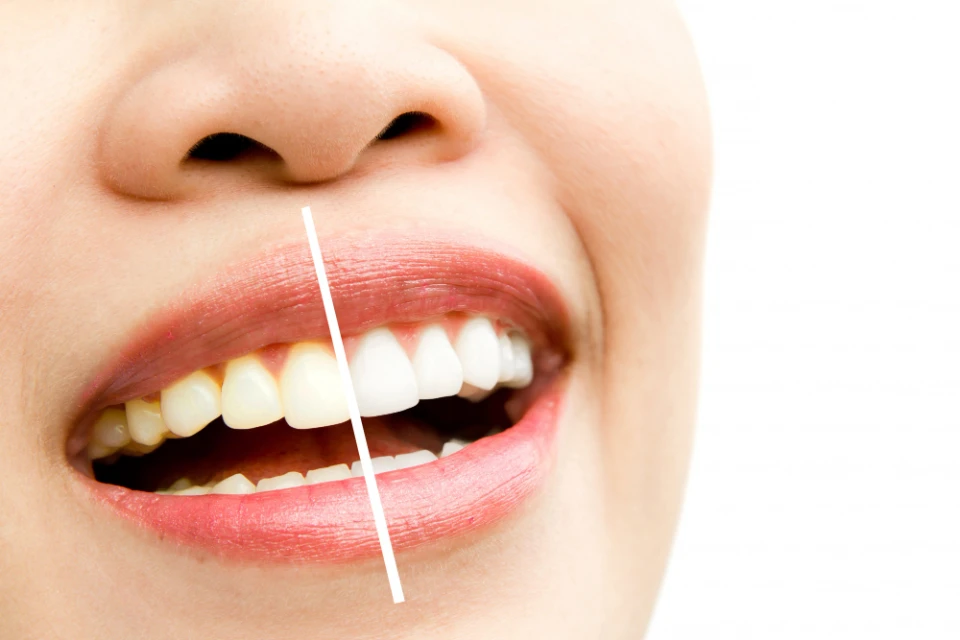 blanqueamiento dental goya banner 3