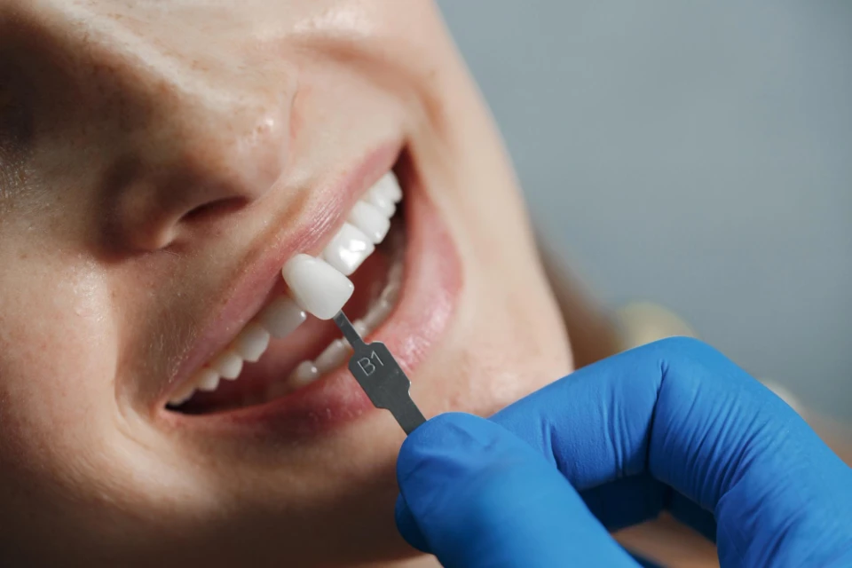 carillas dentales goya banner 2