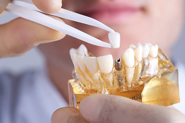 implantes-dentales-mitos-y-realidades-que-debes-conocer 1