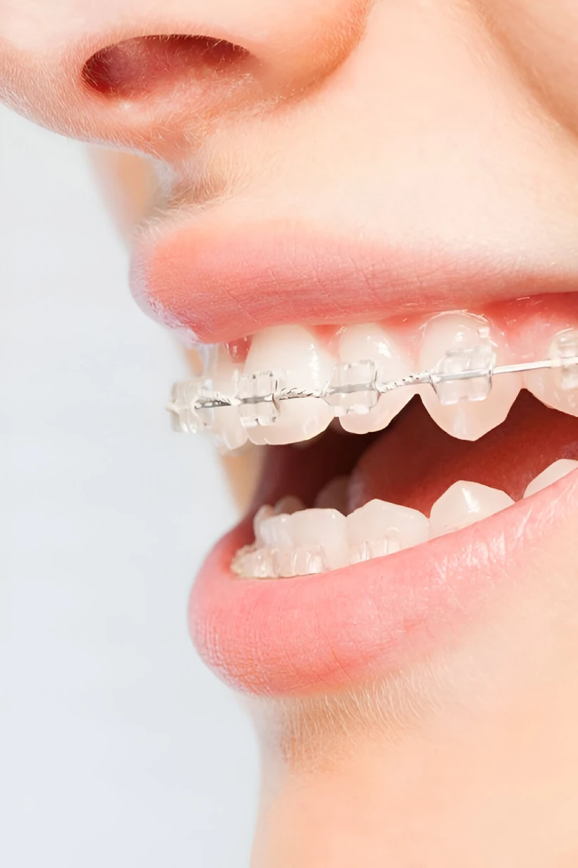 brackets esteticos madrid detalle de brackets esteticos