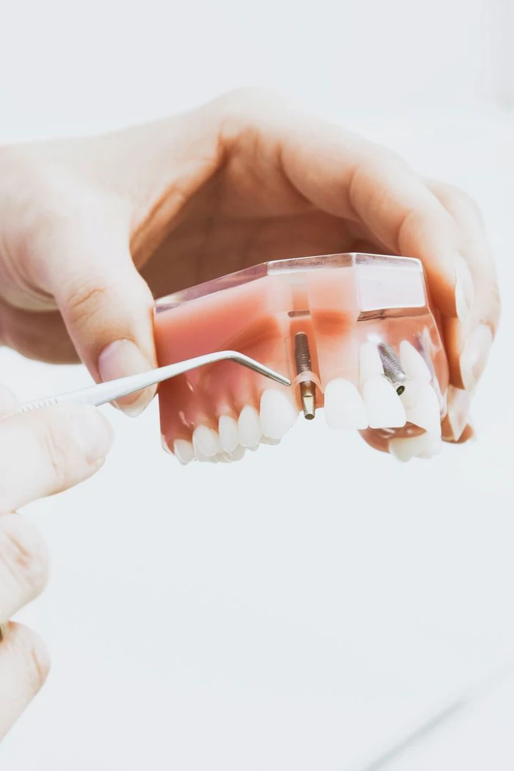 implantes-dentales-goya-imagen-explicativa-de-implante