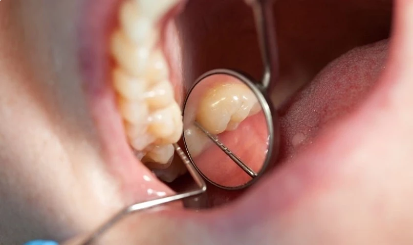periodoncia goya detalle de encias