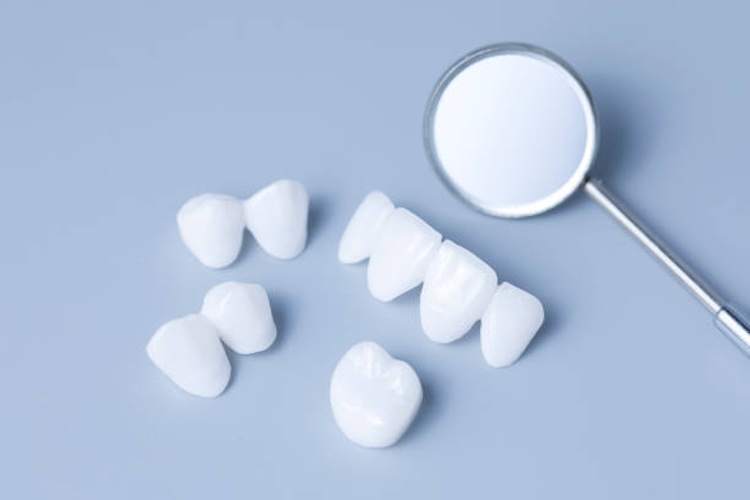 beneficios de las coronas dentales para restaurar tu sonrisa 1