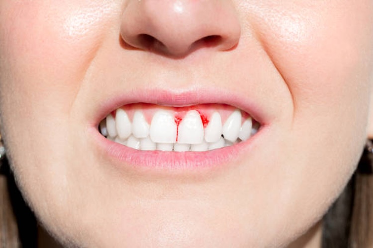 Woman with bleeding gums. Periodontal disease, avitaminosis, gingivitis, scurvy. High quality photo