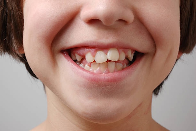 soluciones para dientes torcidos sin brackets tradicionales 1