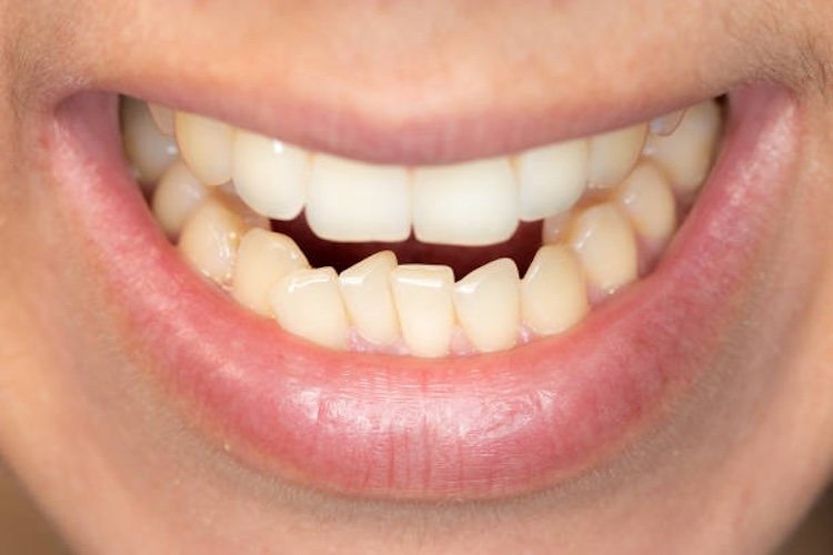 Displacement of teeth of a young caucasian man