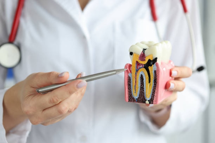 Doctor showing carious cavity with ballpoint pen on plastic artificial tooth model closeup. Dental care concept