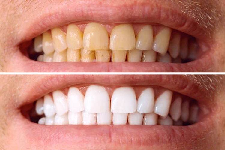 blanqueamiento dental 1