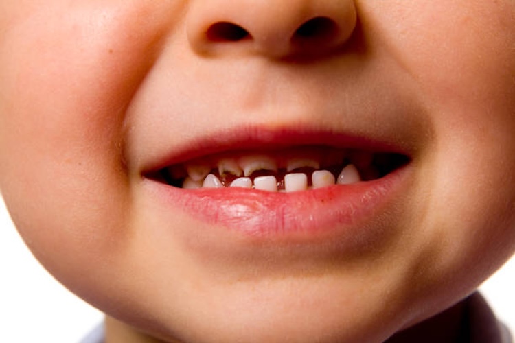 cuidado dental en ninos 1