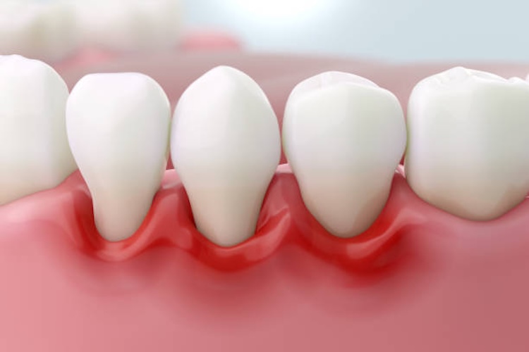 periodontitis sintomas tratamientos y como evitarla a tiempo 1